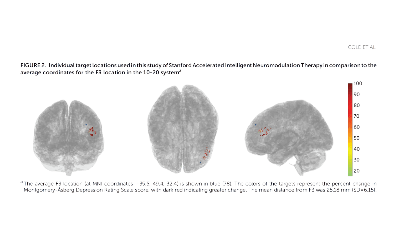 Cole et al study graphic showing brain scans from different angles of the targets representing the percent change in Montgomery-Äsberg Depression Rating Scale score, with dark red indicating greater change. Most of the dots are in one area and dark red.